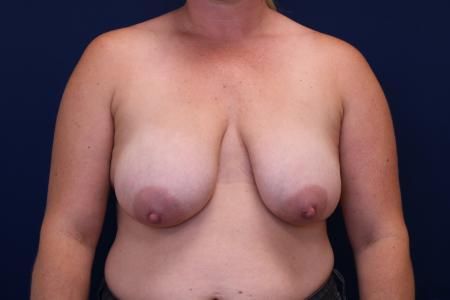 Before image 1 Case #112106 - Breast Lift