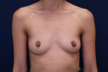 Before image 1 Case #112476 - Breast Augmentation