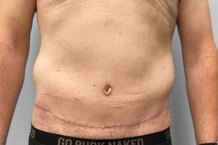 After Case #114696 - Body Lift