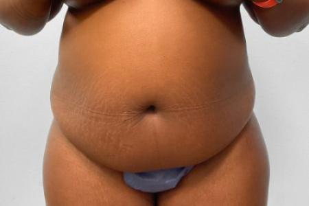 Before image 1 Case #115221 - Tummy Tuck & 360 Liposuction