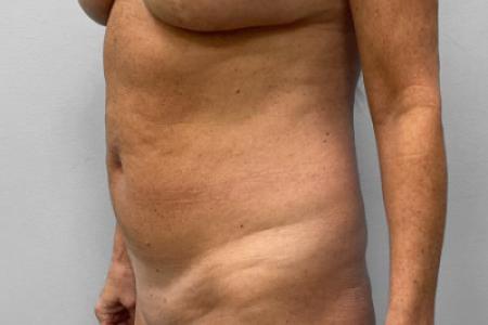 Before Case #114891 - Abdominoplasty