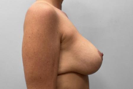After Case #114871 - Breast Implant Exchange and Lift