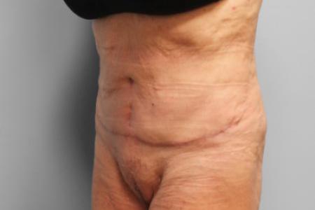 After Case #114896 - Tummy Tuck & Lipo