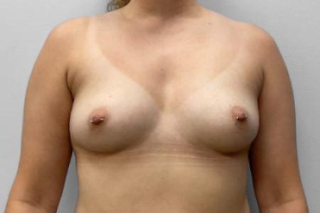 Before image 1 Case #115171 - Breast Augmentation