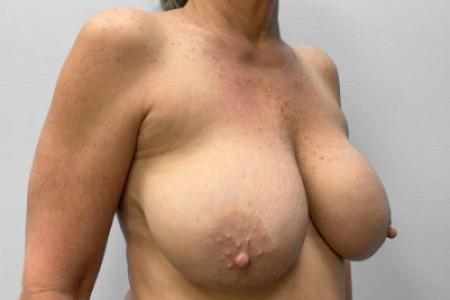 Before Case #114866 - Breast Implant Exchange