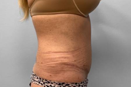 After Case #114891 - Abdominoplasty