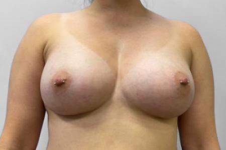 After image 1 Case #115171 - Breast Augmentation