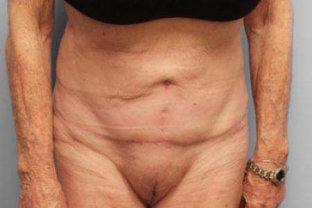 After Case #114896 - Tummy Tuck & Lipo