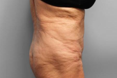 After Case #114896 - Tummy Tuck & Lipo