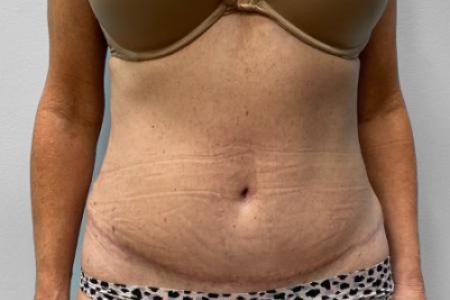 After Case #114891 - Abdominoplasty