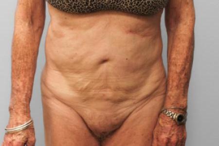 Before Case #114896 - Tummy Tuck & Lipo