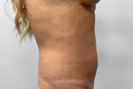 Before Case #114891 - Abdominoplasty