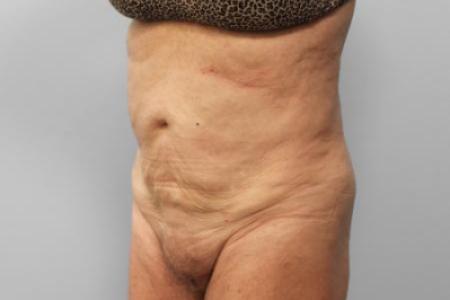 Before Case #114896 - Tummy Tuck & Lipo