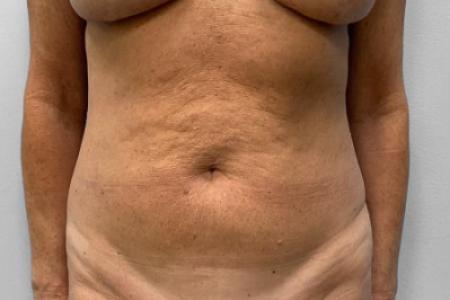 Before Case #114891 - Abdominoplasty