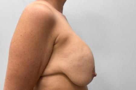 Before Case #114871 - Breast Implant Exchange and Lift