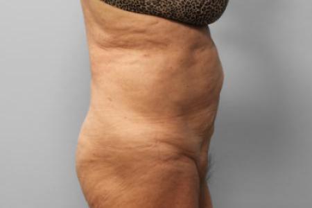 Before Case #114896 - Tummy Tuck & Lipo