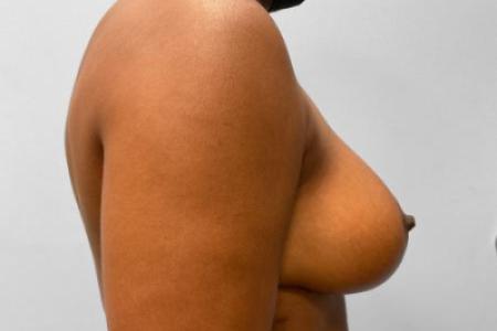 After image 3 Case #115716 - Breast Reduction