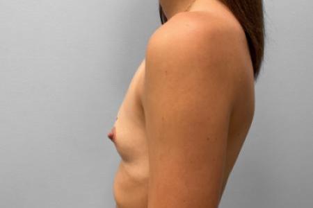 Before image 3 Case #115541 - Breast Augmentation