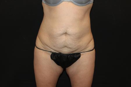 Before image 1 Case #115486 - Abdominoplasty