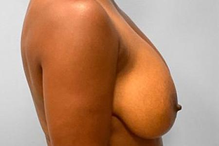 Before image 3 Case #115716 - Breast Reduction