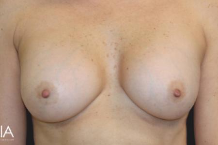 After Case #116771 - 32 year-old patient | Breast Augmentation