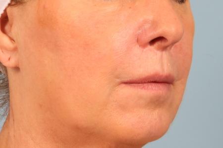 After image 2 Case #116561 - Lip Lift