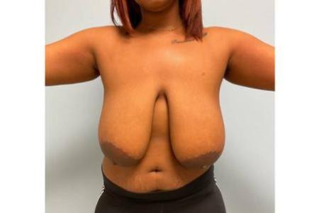 Before image 1 Case #112296 - Breast reduction