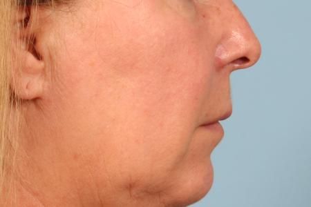 Before image 3 Case #116561 - Lip Lift