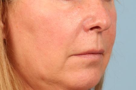Before image 2 Case #116561 - Lip Lift