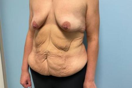 Before image 3 Case #112306 - Breast Lift with implants