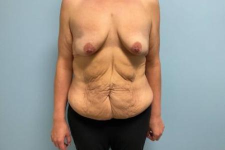 Before image 1 Case #112306 - Breast Lift with implants