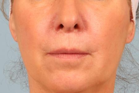 After image 1 Case #116561 - Lip Lift