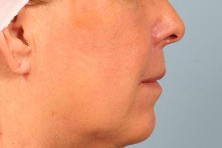 After image 3 Case #116561 - Lip Lift