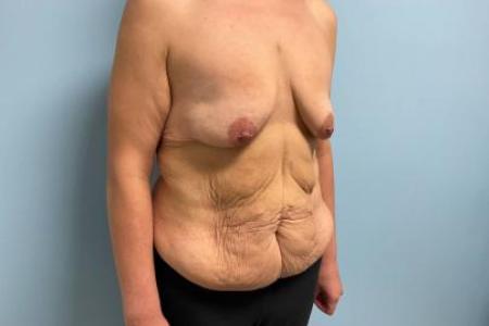 Before image 2 Case #112306 - Breast Lift with implants