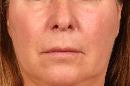 Before image 1 Case #116561 - Lip Lift