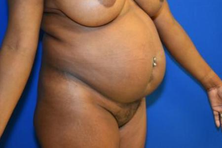 Before image 1 Case #116121 - Abdominoplasty with Wide Diastasis
