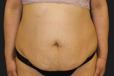 Before image 1 Case #116291 - 39 year old patient | Tummy Tuck 