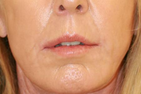 After image 1 Case #117751 - Corner Lip Lift with Co2 Laser Resurfacing