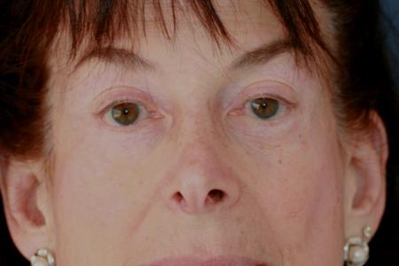 After image 1 Case #117511 - Eyelid Rejuvenation