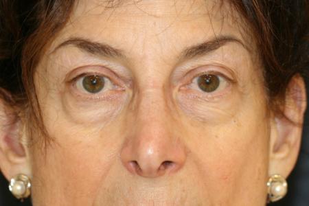 Before image 1 Case #117511 - Eyelid Rejuvenation