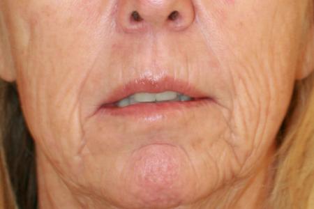 Before image 1 Case #117751 - Corner Lip Lift with Co2 Laser Resurfacing