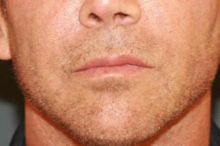 Before image 1 Case #118701 - Male Upper Lip Lift