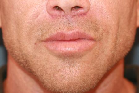 After image 1 Case #118701 - Male Upper Lip Lift