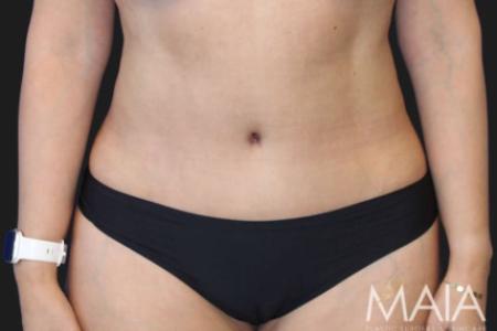 After image 1 Case #119276 - 48 year-old Patient | Tummy Tuck