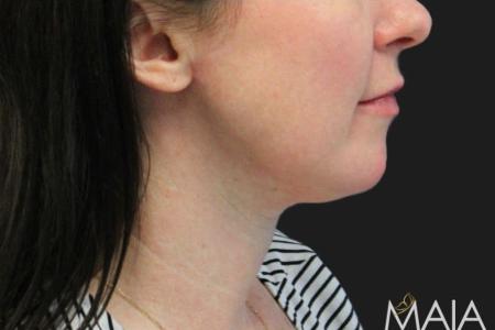 After image 2 Case #119226 - 43 year old Patient | Neck Lift 