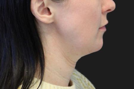 Before image 2 Case #119226 - 43 year old Patient | Neck Lift 