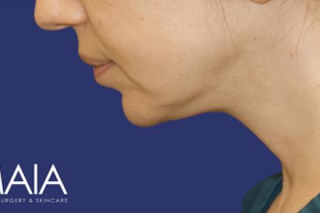 After Case #119361 - 43 year-old Patient | Neck Lift