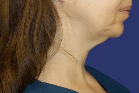 Before Case #119361 - 43 year-old Patient | Neck Lift