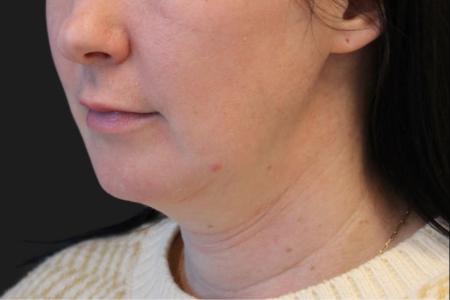 Before image 1 Case #119226 - 43 year old Patient | Neck Lift 
