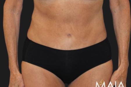 After image 1 Case #119271 - Mid 60s Patient | Menopause Makeover